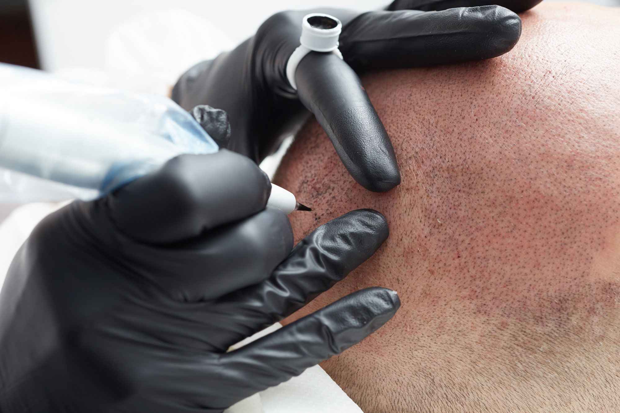 Artist performing scalp micropigmentation