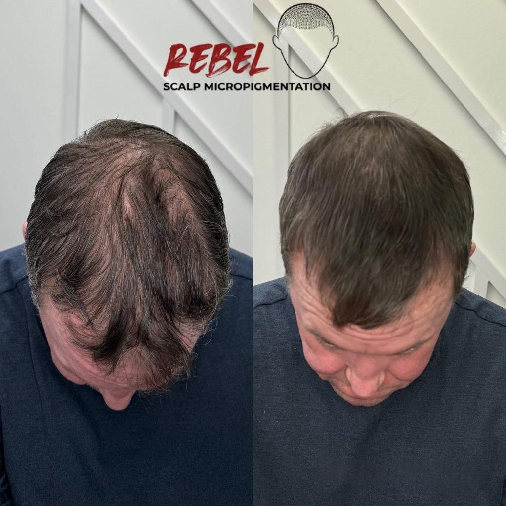 Scalp micropigmentation result at Rebel Aesthetics in New Jersey.
