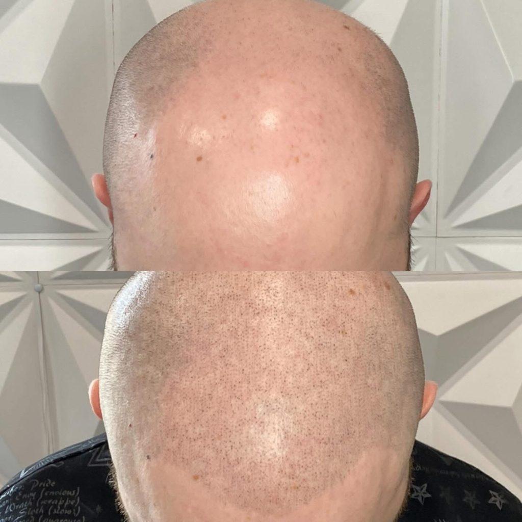 Scalp micropigmentation result at Rebel Aesthetics in New Jersey.