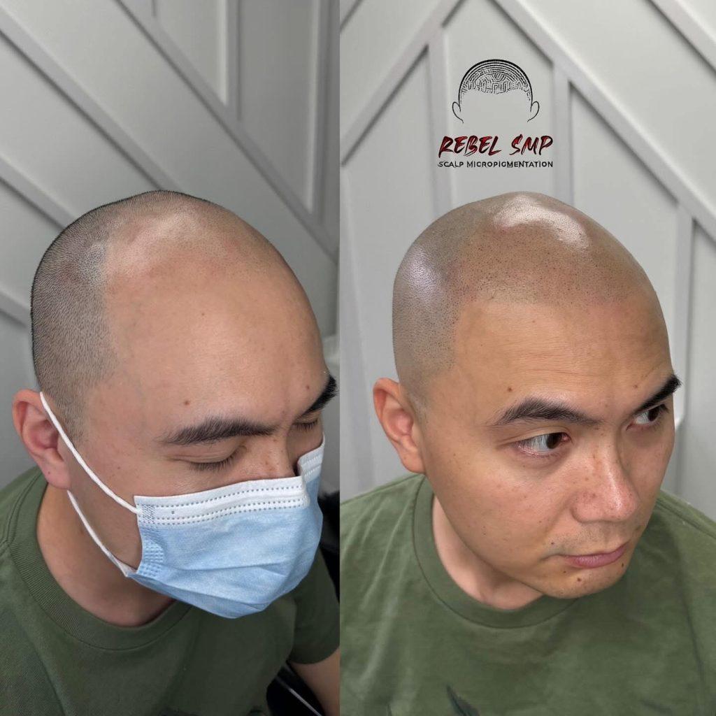 Scalp micropigmentation result at Rebel Aesthetics in New Jersey.