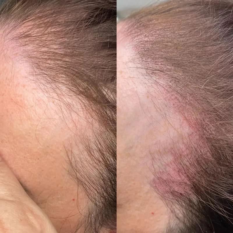 Scalp micropigmentation density result at Rebel Aesthetics in New Jersey.