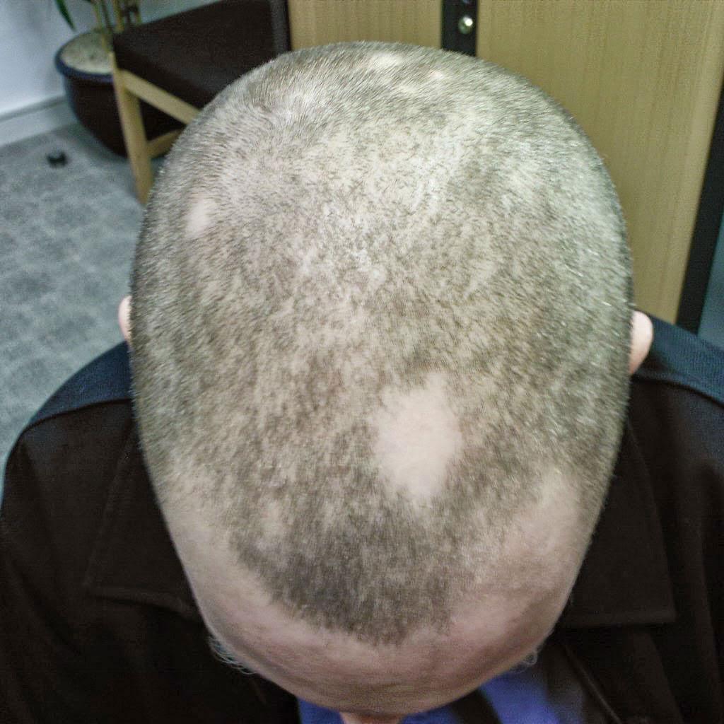 SMP for Alopecia example 1