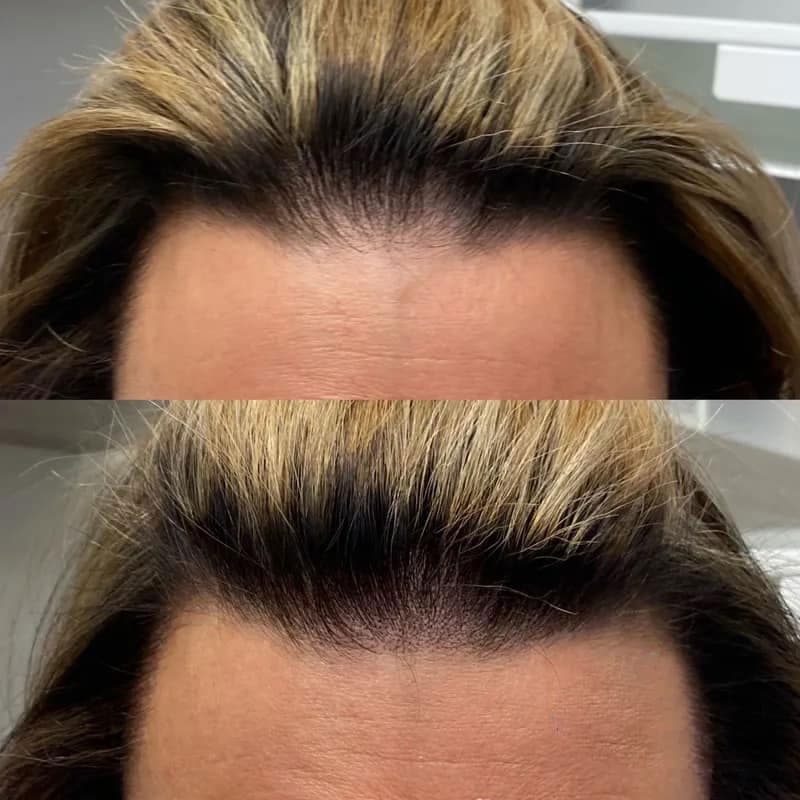 SMP for women result at Rebel Aesthetics in New Jersey.