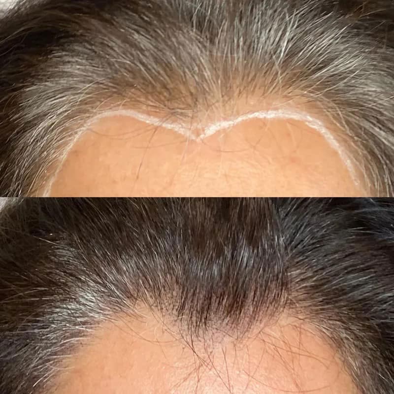 Scalp micropigmentation result at Rebel Aesthetics in New Jersey.