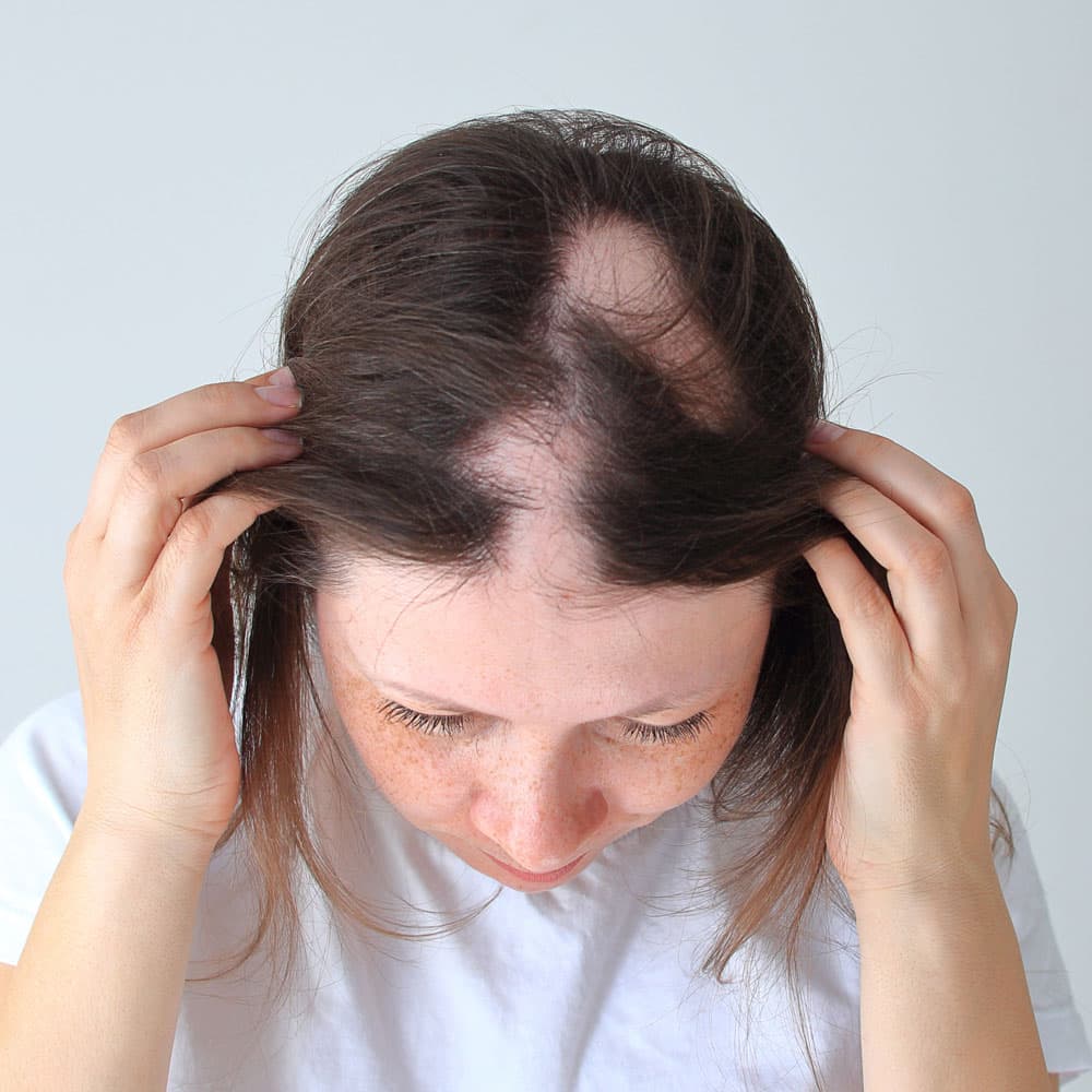 What SMP can actually do for women with alopecia areata