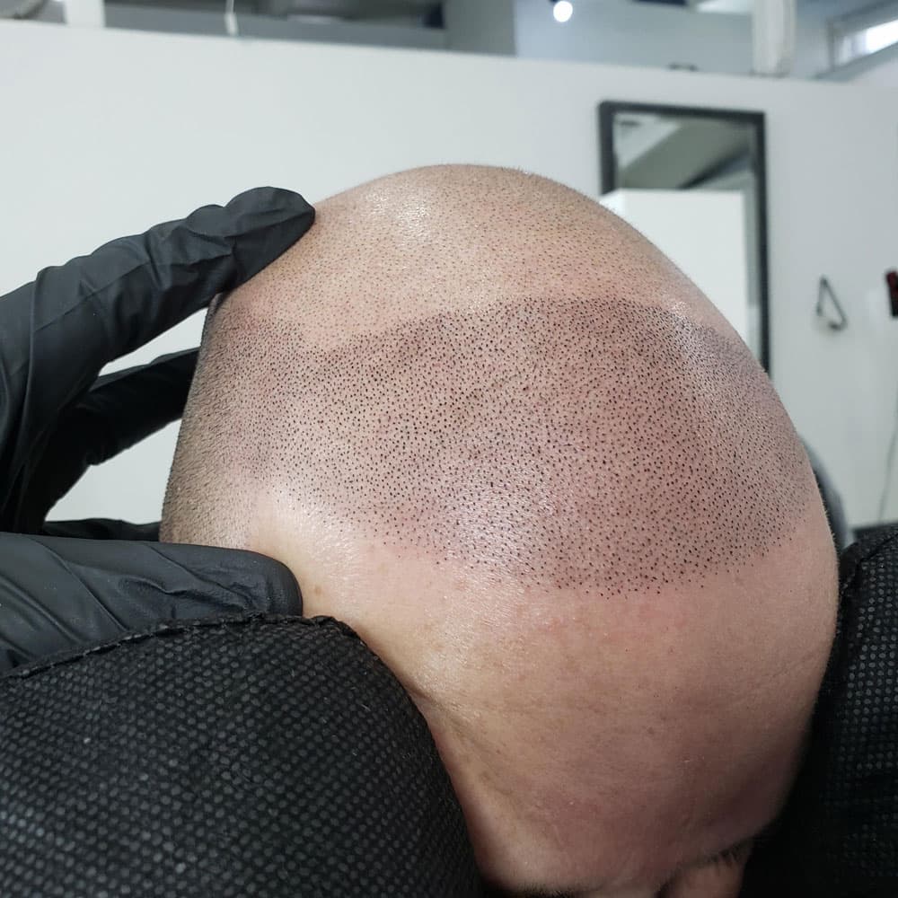 What you'll actually pay for scalp micropigmentation