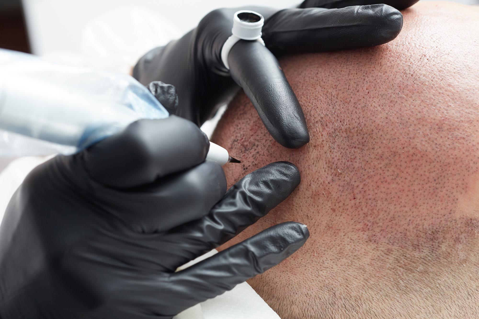 5 things to know before SMP on a receding hairline