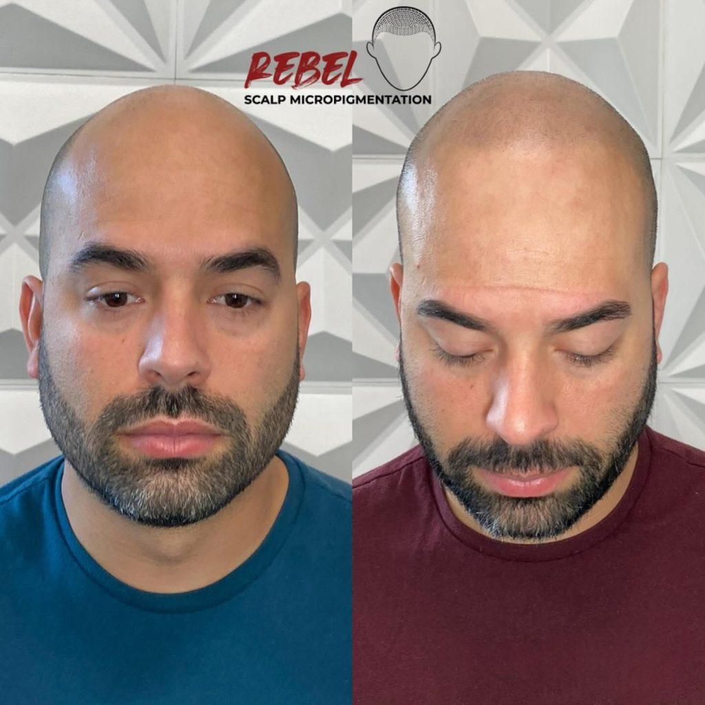 Scalp micropigmentation before and after at Rebel Aesthetic