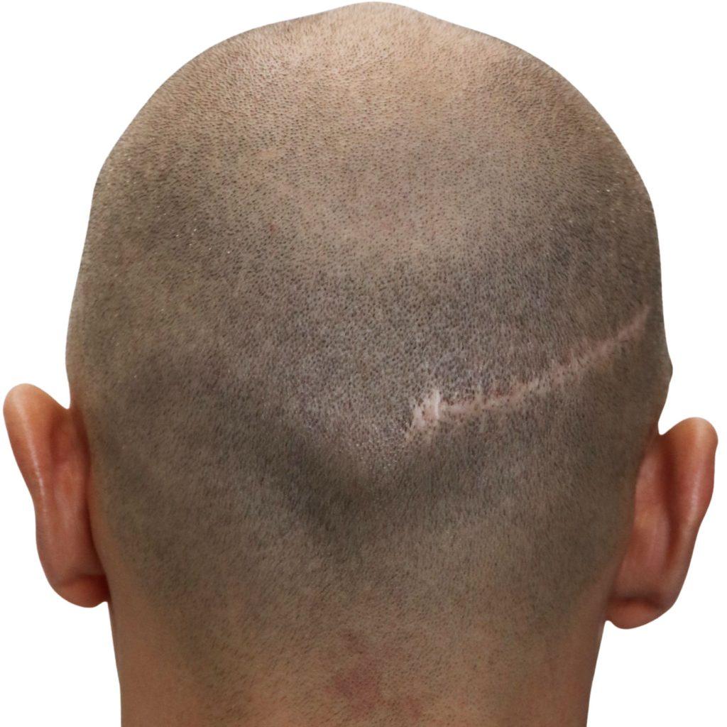 SMP for scarring example 3