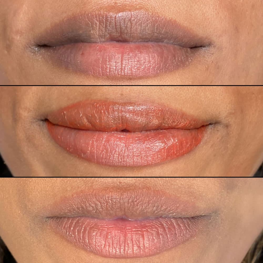 Dark Lip Neutralization