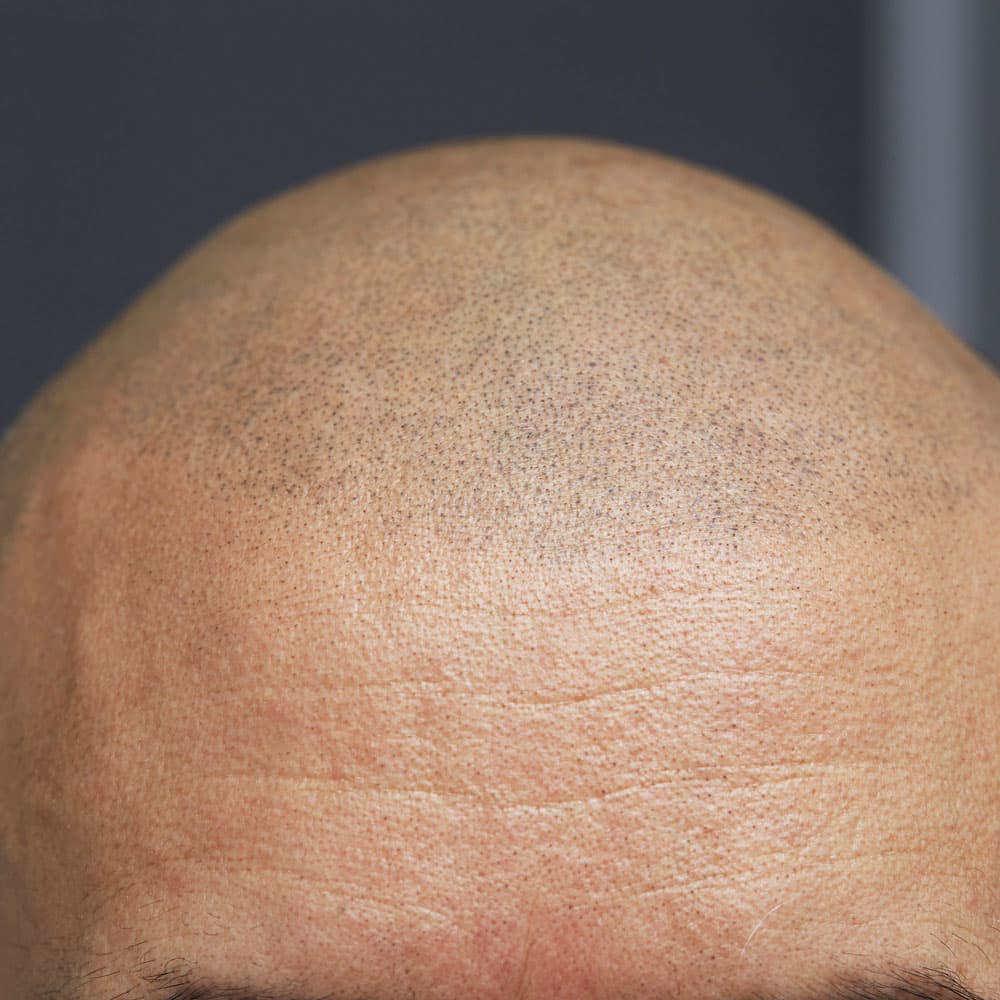 Scalp Micropigmentation example 1